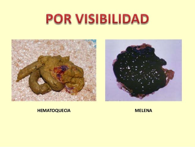HECES CON SANGRE heces con sangre: