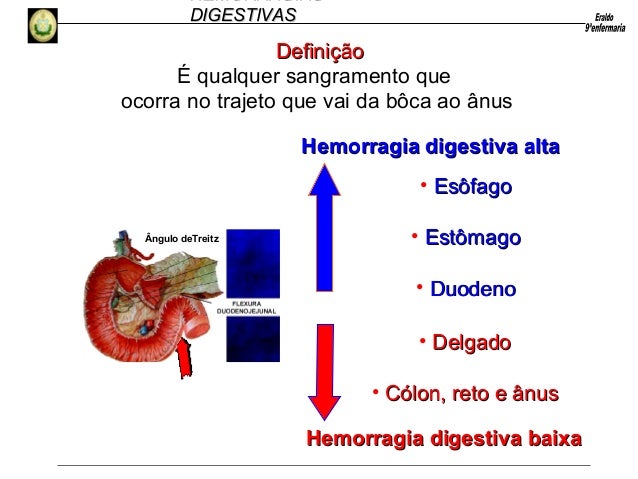 Hemorragia Digestiva