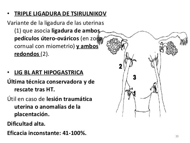 hemorragia postparto- técnicas quirúrgicas