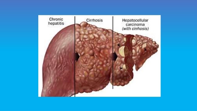 Signs of hepatitis c in adults