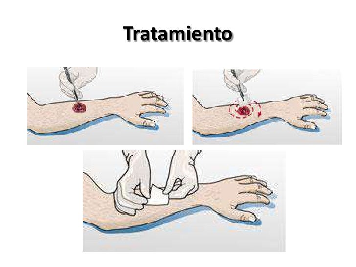 El medio ha sanado el hongo