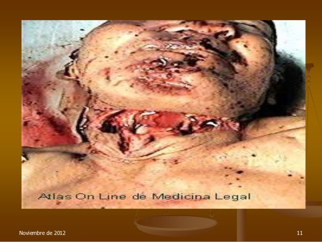 Heridas por arma blanca