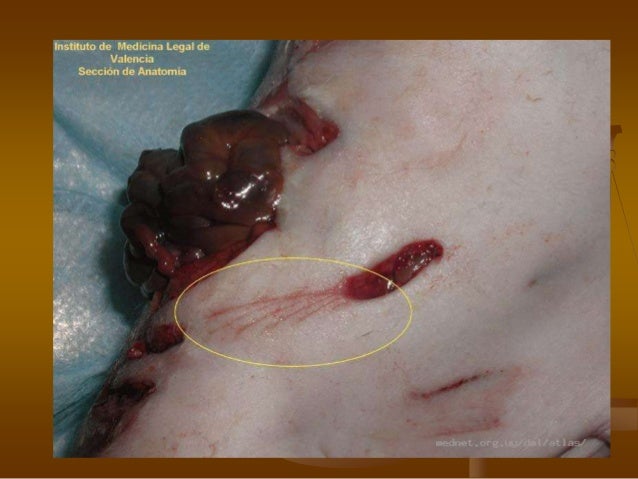 Heridas por arma blanca