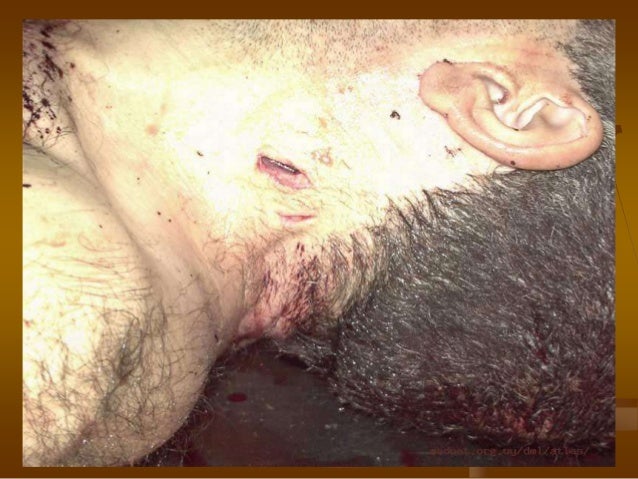 Heridas por arma blanca