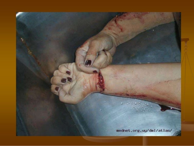 Heridas por arma blanca