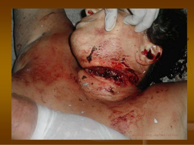 Heridas por arma blanca
