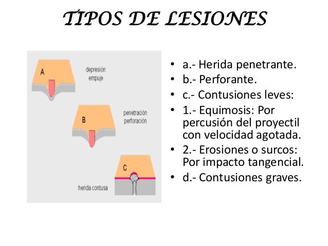Tipos De Heridas Por Arma De Fuego es.slideshare.net