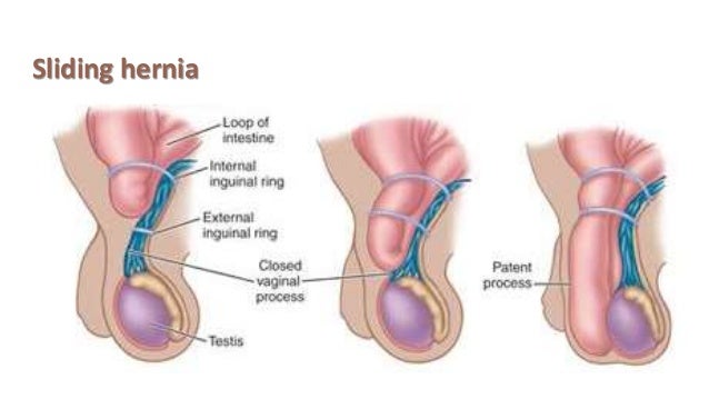 Male Sexual Dysfunction Common After Hernia Repair Surgical
