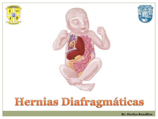 Hernia diafragmática