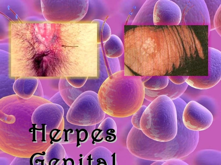 Site de rencontre herpes genital