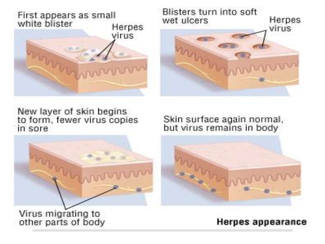 GENITAL HERPES: The Eight Stages of Genital Herpes
