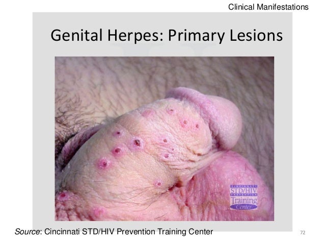 pictures of herpes outbreaks #11