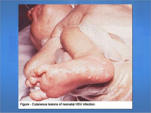 Pediatric Herpes Simplex Virus Infection: Practice ...