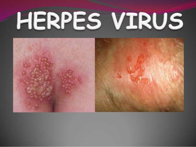 STD Facts - Genital Herpes - cdc.gov