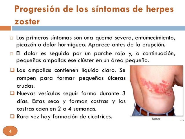 Herpes Simplex | Genital Herpes | Herpes Simplex 1 ...