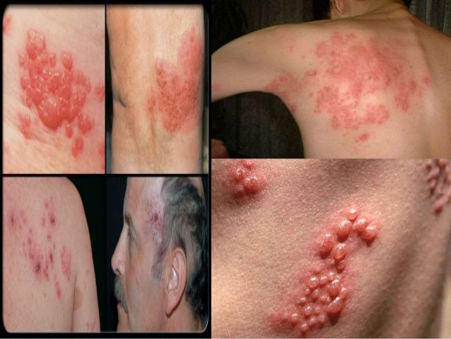 Herpes zoster Herpes zoster