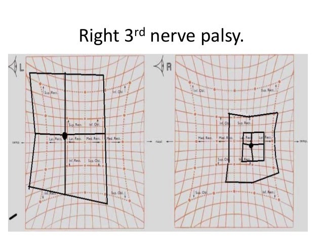hess test diplopia charting