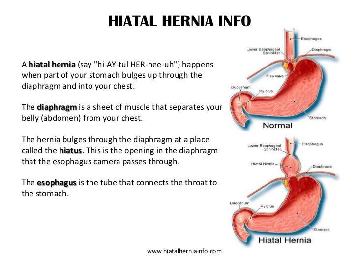 Hiatus Hernia Diet After Surgery