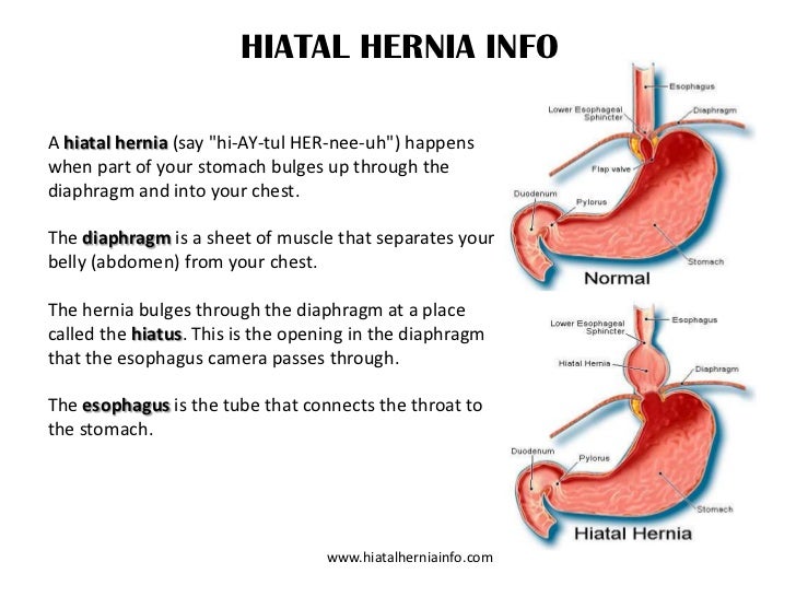 hernia diagram hiatal hernia info hernia diagram hiatal hernia info