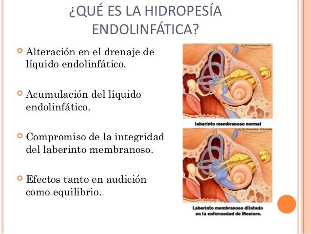 Hidropesía Endolinfática