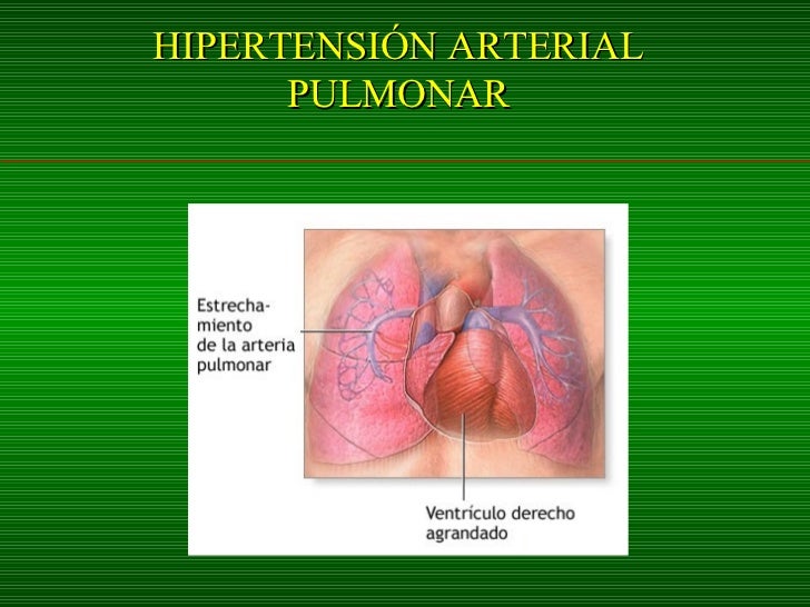 Hipertension Arterial Pulmonar Hipertension Arterial Pulmonar