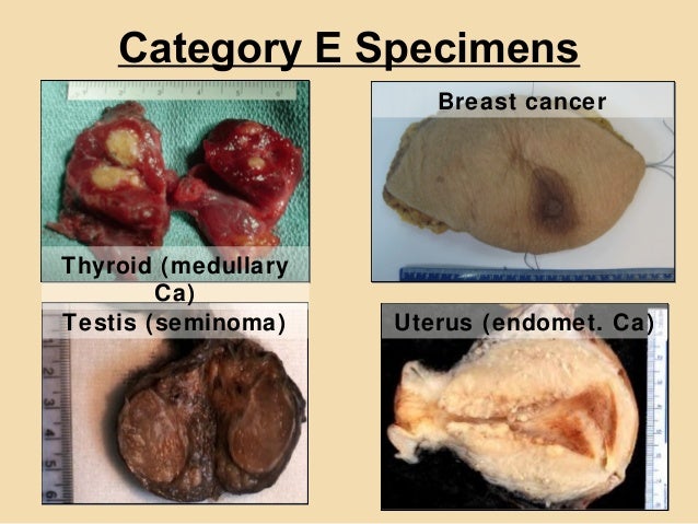 Womb cancer outlook cervical cancer staging paintings up