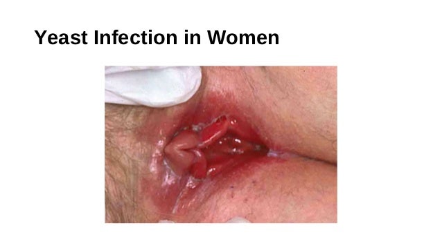 How do you cure an internal fungal infection?. Thread ...