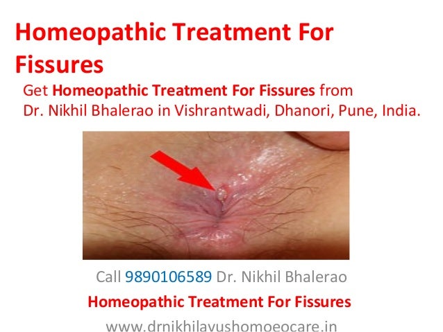 Healing an anal fissure