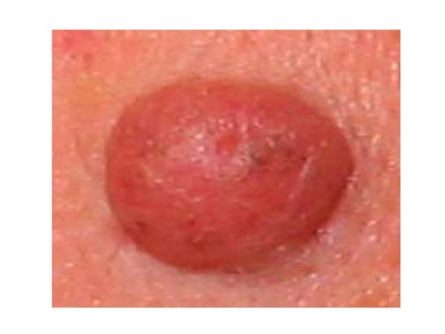 what causes skin tag #10