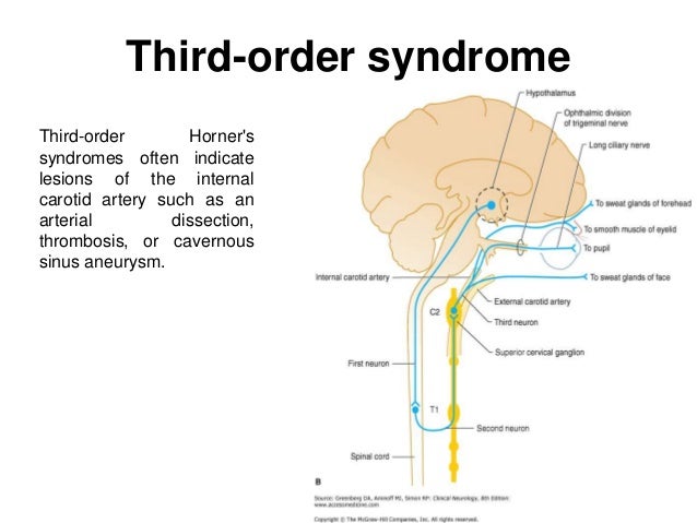 cavernous sinus thrombosis