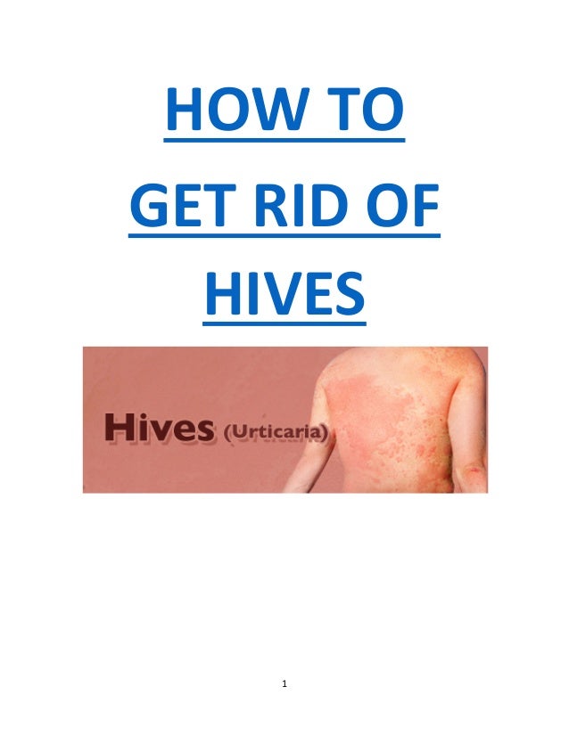 How to treat hives