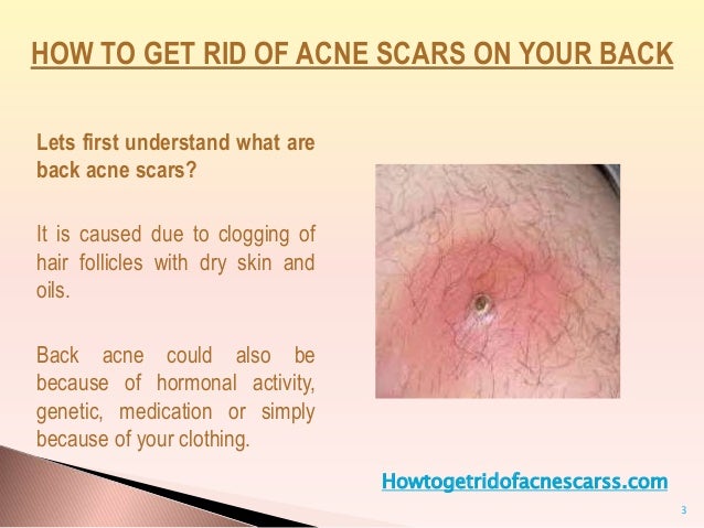 How To Get Rid Of Acne Scars At Home
