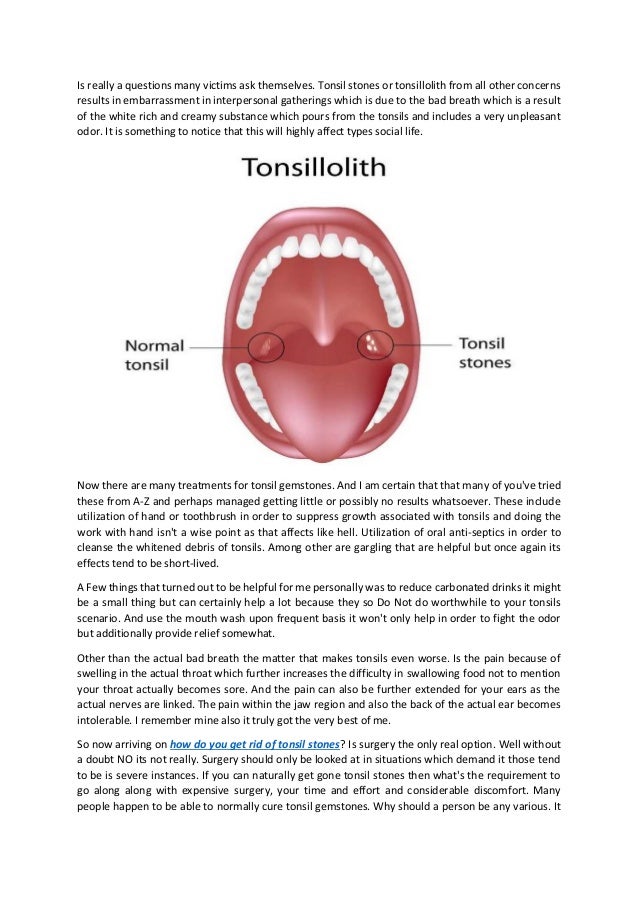 How To Get Rid Of Tonsil Stones Forever Naturally How To Get Rid Of Tonsil Stones Forever Naturally