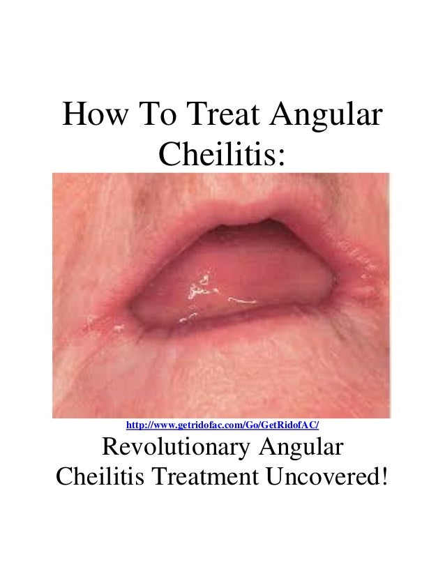 How To Treat Angular Cheilitis Prelease2015