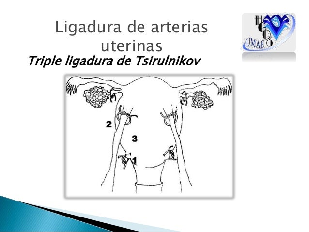 Ligadura de arterias uterinas