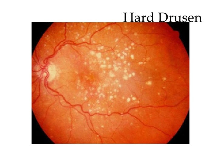 Pattern Macular Dystrophy Icd 10 | macular degeneration Pattern Macular Dystrophy Icd 10 | macular degeneration