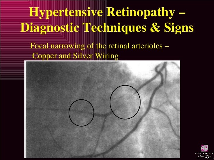 Hypertensive Retinopathy