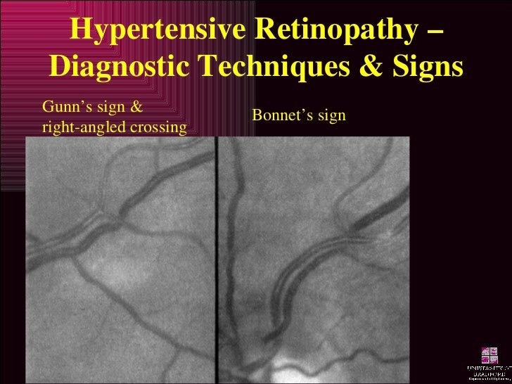 Hypertensive Retinopathy Hypertensive Retinopathy