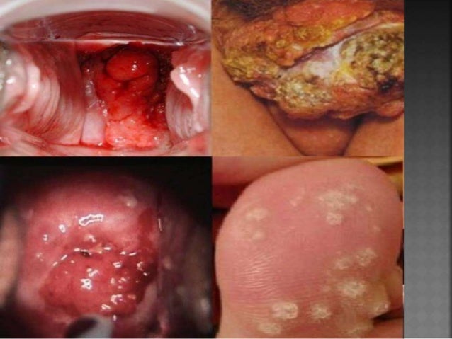 Pictures of STDs: Herpes, Genital Warts, Gonorrhea, STD ...