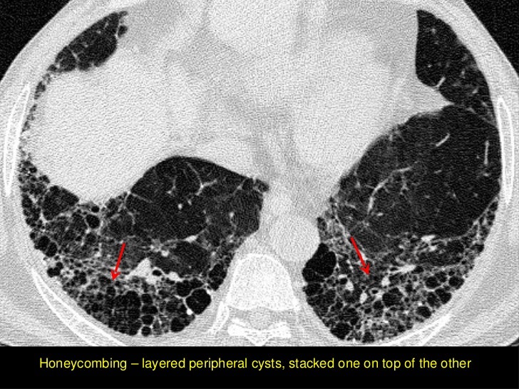 HRCT in Diffuse Lung Diseases II UIP pattern, IPF)