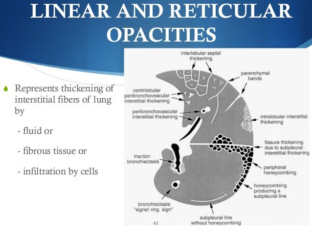 remedy for mesothelioma