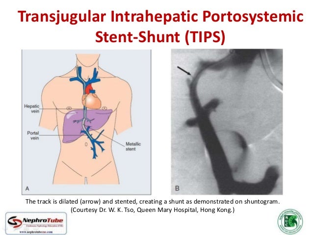 Renal Hemodialysis