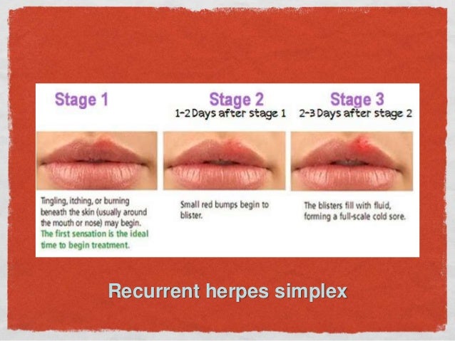 herpes corner of mouth #10