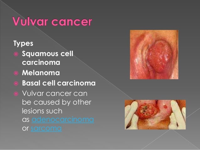 cervical rib treatment india cervical cancer fees by using country