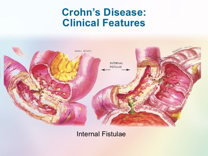 IBD irritated?