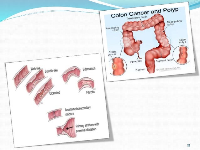 Cancer poumon traitement nouveau most cancers colorectal definition