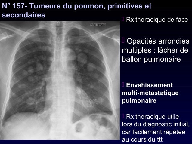 cancer du pancreas quelle alimentation