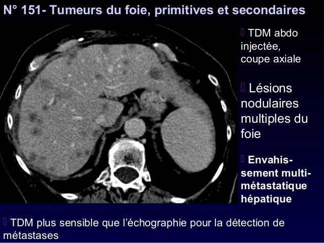 most cancers de l'intestin reasons ligue contre le cancer montpellier