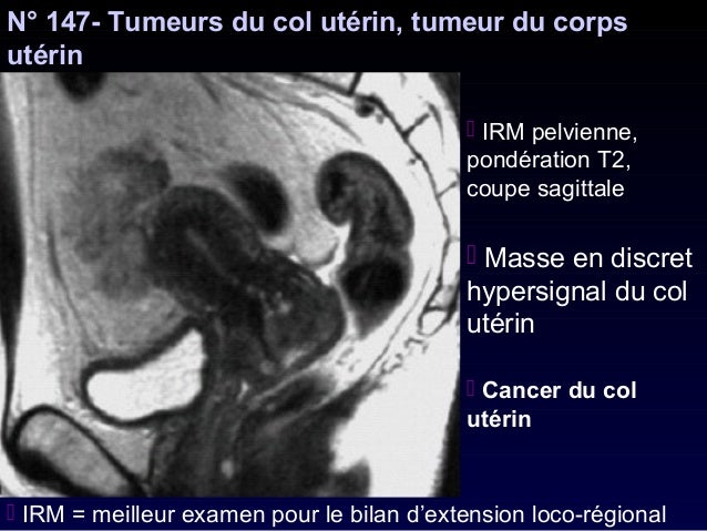 Most cancers Ovaire Hcg