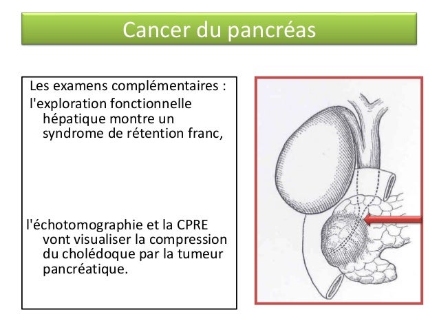 Signe most cancers Hepatique